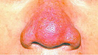 深圳治療酒糟鼻癥狀圖片