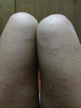 蕁麻疹快治療方法